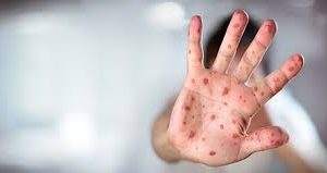 ۲۰ مورد قطعی ابتلا به سرخک در فارس شناسایی شد