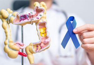 کاهش روند ابتلا به سرطان معده و افزایش سرطان روده بزرگ